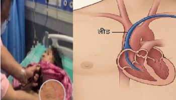 दिल की धड़कन थमने को थी… पर Bokaro के इस हॉस्पिटल ने लौटा दी ज़िंदगी
